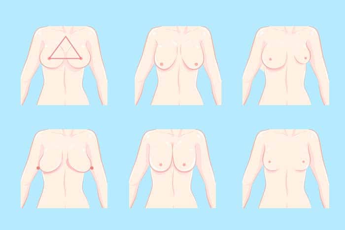 Types of breast  Breast, Asymetrical, Warner's